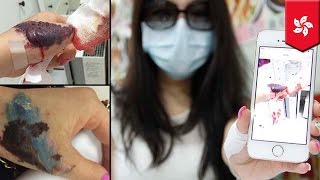 Tattoo removal gone wrong Hong Kong woman’s hand maimed by laser procedure [upl. by Arahset]