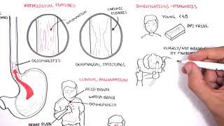 GORD GERD Gastro Oesophageal Reflux Disease  Overview pathophysiology treatment [upl. by Jerrome505]