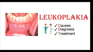 Leukoplakia  Causes Diagnosis amp Treatment [upl. by Nirret898]