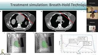 Breast Treatment Planning amp Simulation [upl. by Seerdi]