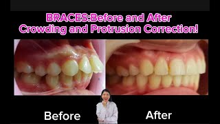 BracesBefore and After Crownding and Protrusion Correction [upl. by Minerva623]