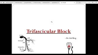 Trifascicular block Dr Akif Baig [upl. by Nashner]