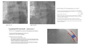 STEMI primary PCI technical tips including for STEMI with shock Elias Hanna [upl. by Gnouhk]