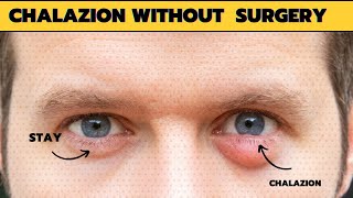 How to get rid of chalazion at home overnight  fast without surgery [upl. by Karisa]