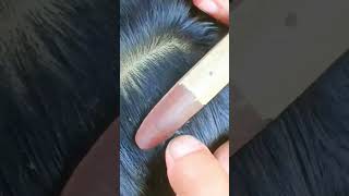 Picking a thousand of lice on hair How to get rid of lice hair wigs skincare [upl. by Valer]