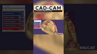 Dental Crowns in Making with CADCAM Exocad Software [upl. by Saihttam]