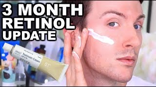 MY FIRST 3 MONTHS ON RETIN A  RETINOL BEFORE AND AFTER [upl. by Akimik]