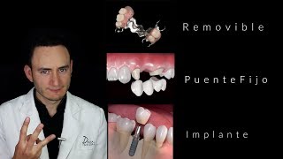 Puentes vs Implantes  ¿Cuál es la mejor opción  Dentista en Querétaro [upl. by Olegnaed282]