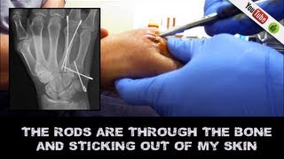 Removing 4 rods pins from Boxers Break  No anesthetic [upl. by Haleigh]