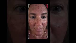 Broad Band Light Therapy Before amp After beforeandafter worthit pain brightskin relatablemom [upl. by Wesa]