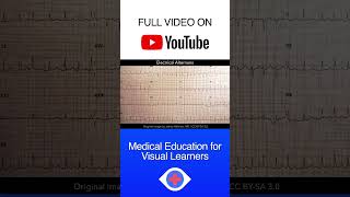 Electrical Alternans ECG shorts [upl. by Ielirol22]