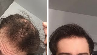 Treatment Dutasteride Ru58841 Minoxidil But Still Shedding [upl. by Arac]