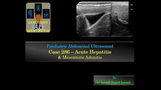 Ultrasound Case 286  Acute Hepatitis and Mesenteric Adenitis [upl. by Convery]