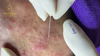 Loan Nguyen Acne Treatment 361pre [upl. by Anikal]