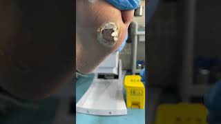 Callus removal and Dead skin removal from Feet ep29  Yin Clinic [upl. by Suzi675]