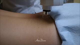 Treatment of Stretch Marks with Fractional CO2 Laser by Amoderm [upl. by Nuhs]