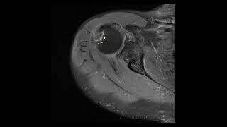 How nondisplaced GT fracture of humerus improve in 1 year [upl. by Ihcas]