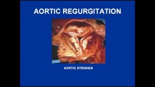 Aortic Stenosis and Regurgitation Variations [upl. by Esme822]