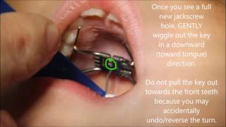 How To Turn a Rapid Palatal Expander [upl. by Htezzil]