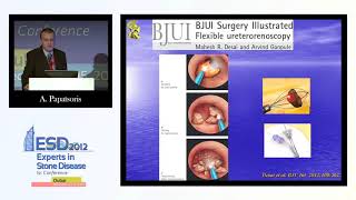 Lithotripsy  Intracorporeal laser lithotripsy [upl. by Nivlem662]