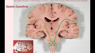 Spastic dysarthria  samples and tutorial [upl. by Koressa]