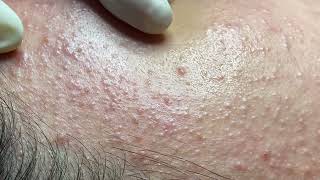 Acne treatment for Spa Linh Mun 2024 148 [upl. by Peria]