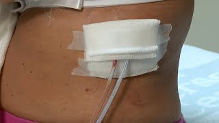 How to care for a postsurgery wound drainage system and gauze dressing [upl. by Ennaerb776]