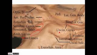 Neurosurgery Temporal lobe anatomy and its implications in temporal lobe epilepsy [upl. by Fiona]