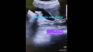 Ultrasound short clipsgall bladder scangall bladder sludgegb sludgecholelithiasisytshorts [upl. by Iahcedrom]