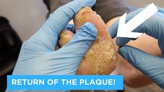 RETURN OF THE PLAQUE  PSORIATIC PLAQUE PART 2 [upl. by Kcin]