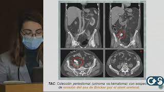 Sesión clínica Estenosis de la Unión Ureteroileal Complicación grave tras cistestomía [upl. by Loella987]