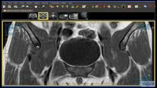 Hip Avulsion Fracture of the Anterior Inferior Iliac Spine [upl. by Hung52]