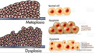 Metaplasia and dysplasia 😀 [upl. by Selmner84]