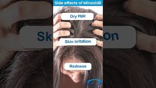 ❇️ Minoxidil for Hair Loss  Side  Effects of Minoxidil ❇️ Benefits of using Derma Roller shorts [upl. by Noma312]