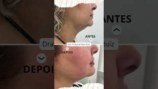 Protocolo FULL Face com Ultraformer Mais informações 11 944440305 harmonizacaofacial beleza [upl. by Reyotal405]