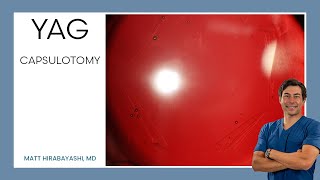 Routine YAG Capsulotomy [upl. by Sanez]