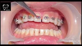 DIASTEMA CLOSURE  BRACES  Orthodontics dentalbraces dentalclinic dental trending anantnag 🙂🙂🙂 [upl. by Ntsyrk]