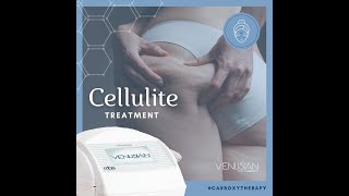 CELLULITE Treatment with carboxytherapy [upl. by Schaaff]