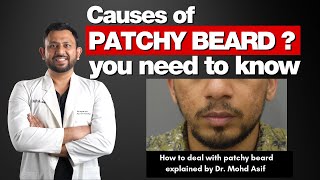 Patchy Beard Causes  Solutions  Treatments To Deal with Patchy Beard [upl. by Shelba840]