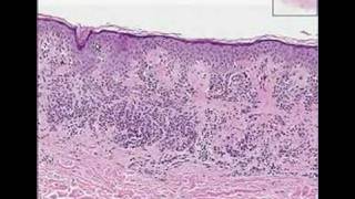 Histopathology SkinCompound Clarks nevus dysplastic nevus [upl. by Tteltrab]