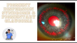 Pigment Dispersion Syndrome and Pigmentary Glaucoma I Eye Dr Explains 2023 [upl. by Airad826]