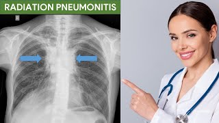 Radiation Pneumonitis [upl. by Silsby]