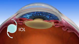 Florida Eye  LENSAR Laser Assisted Cataract Surgery [upl. by Espy992]