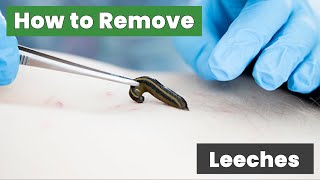 How to Remove Leeches Quick and Easy [upl. by Herod737]