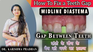 Gaps Between Teeth and Solutions  दाँतो के बीच गेप भरने का इलाज  Midline Diastema Closer Treatment [upl. by Buddie]