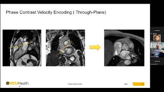 Valvular Heart Disease Evaluation with Cardiovascular Magnetic Resonance  Mohammed Makkiya MD [upl. by Arednaxela579]