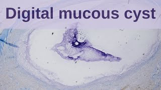 Digital Mucous Cyst  Pathology mini tutorial [upl. by Ynoble]