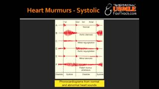 Heart Murmurs  Aortic Stenosis [upl. by Barbara-Anne153]