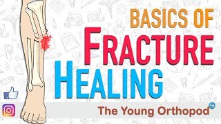 Fracture Healing  ANIMATION  BASICS  The Young Orthopod [upl. by Copland]