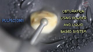 pulpectomy and obturation demonstration using powder and liquid based system [upl. by Atinauq]